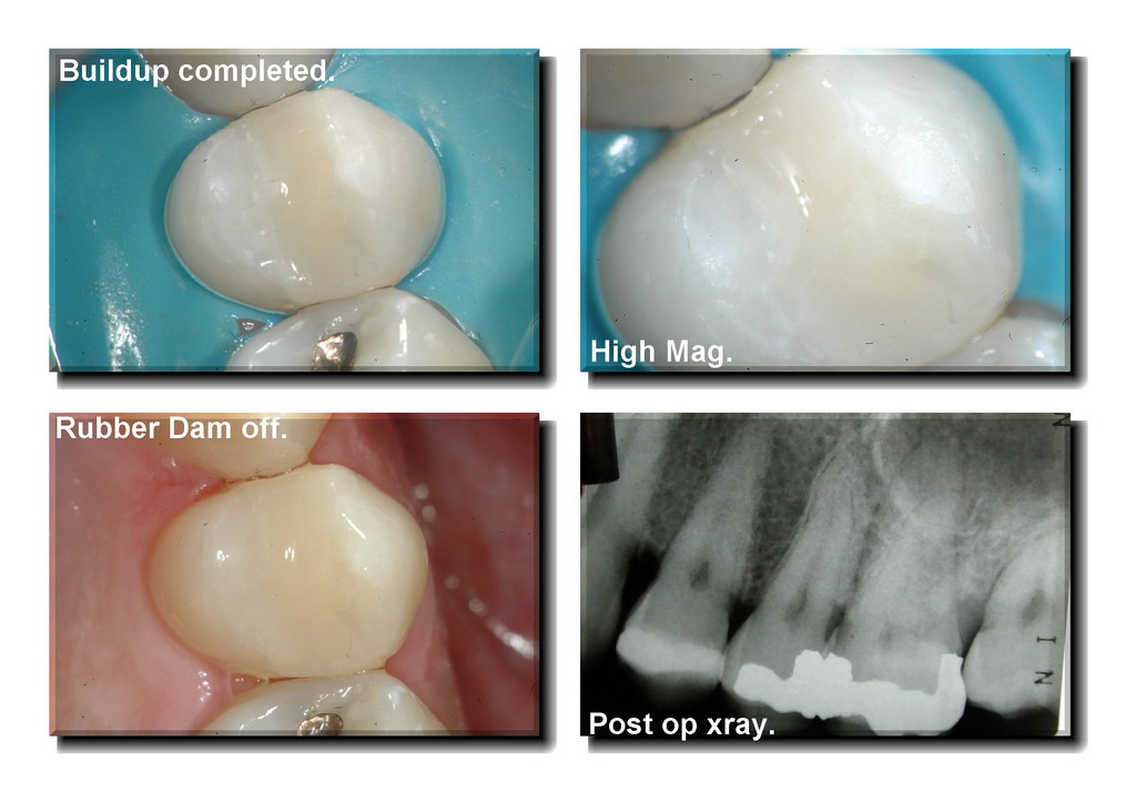 Cracked tooth pg 5_resize.jpg